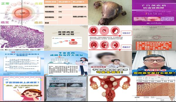 子宫颈病变的症状 - 汕头子宫颈病变是怎么回事
