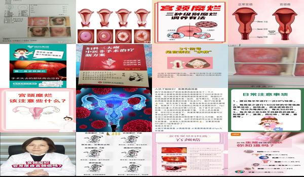 宫颈糜烂2度得*几*大吗 - 汕头2度宫颈糜烂发展为*的机*大不
