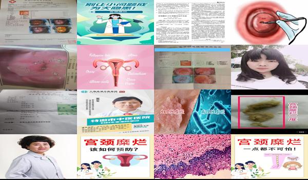 未婚女孩宫颈糜烂 - 汕头未婚女宫颈糜烂