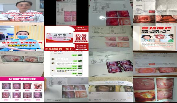 宫颈糜烂中度吃药能好吗 - 汕头宫颈糜烂中度吃药可以好吗