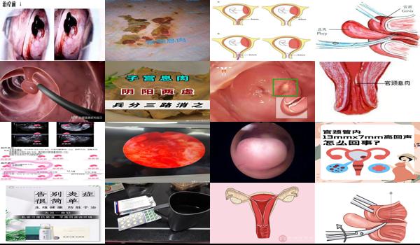 宫颈息肉得花多少钱 - 汕头宫颈息肉多少钱