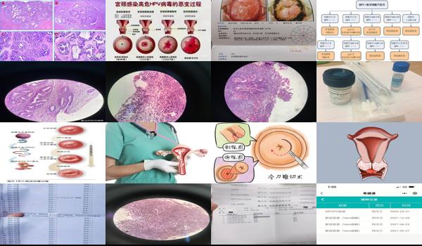 hpv宫颈切片检查多少钱 - 汕头宫颈切片做hpv